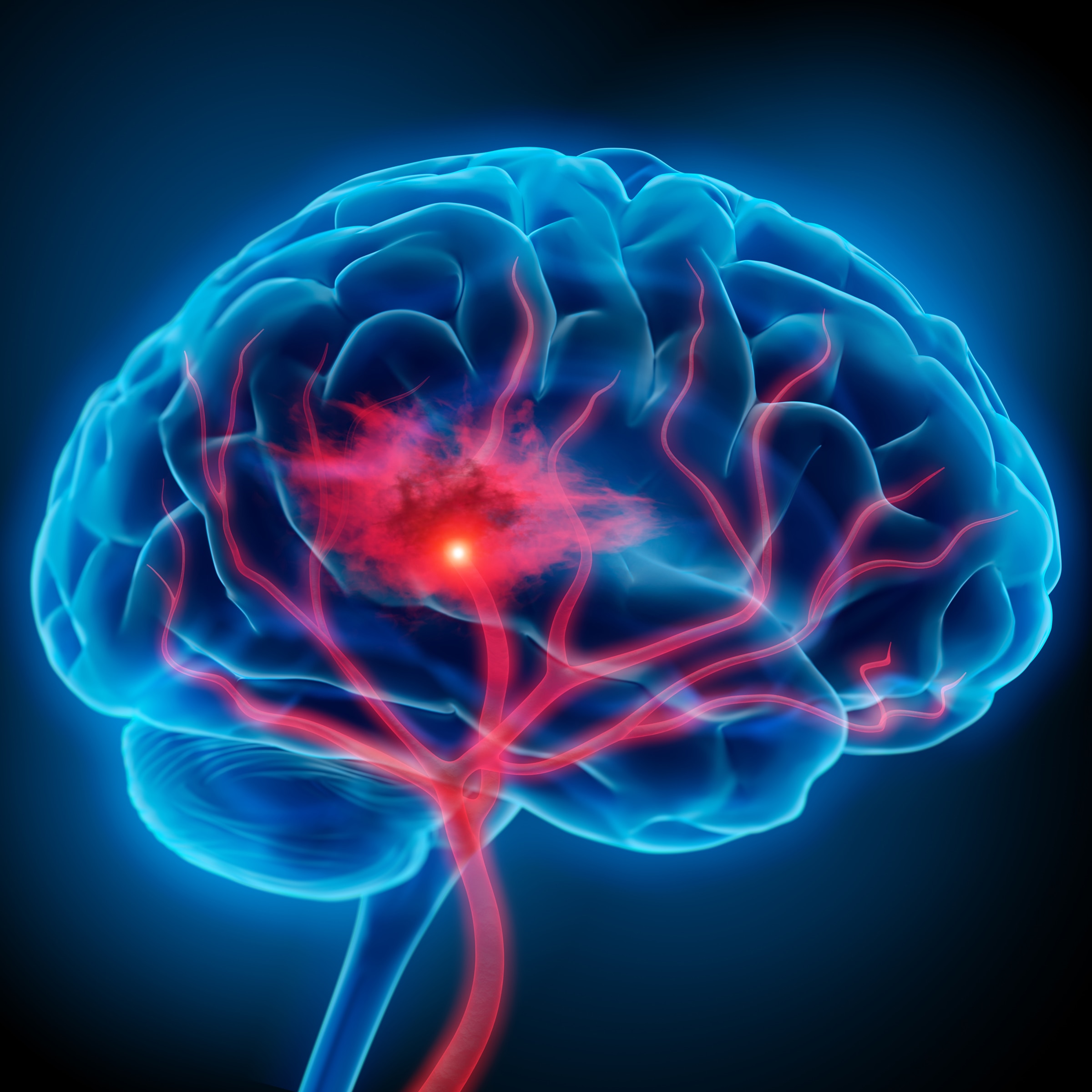 Image of stroke affected brain, Health Edco cardiovascular health education materials and models for heart health education