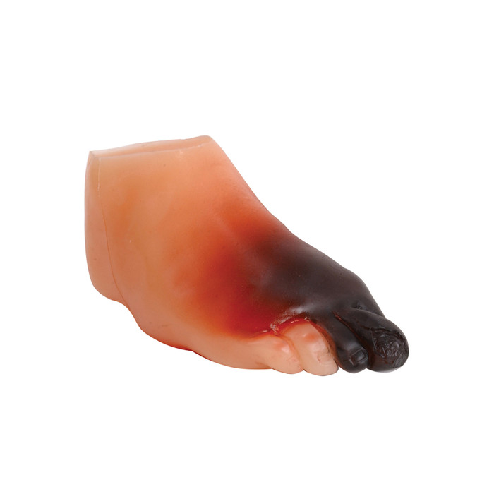 severe diabetic foot model, important foot care, blood glucose, amputated toe, severe infection, gangrene, foot ulcer, Health Edco, 26150