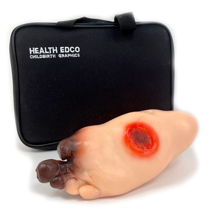 Severe Diabetic Foot Model, health education model of foot with diabetic gangrene and ulcers with case, Health Edco, 26150