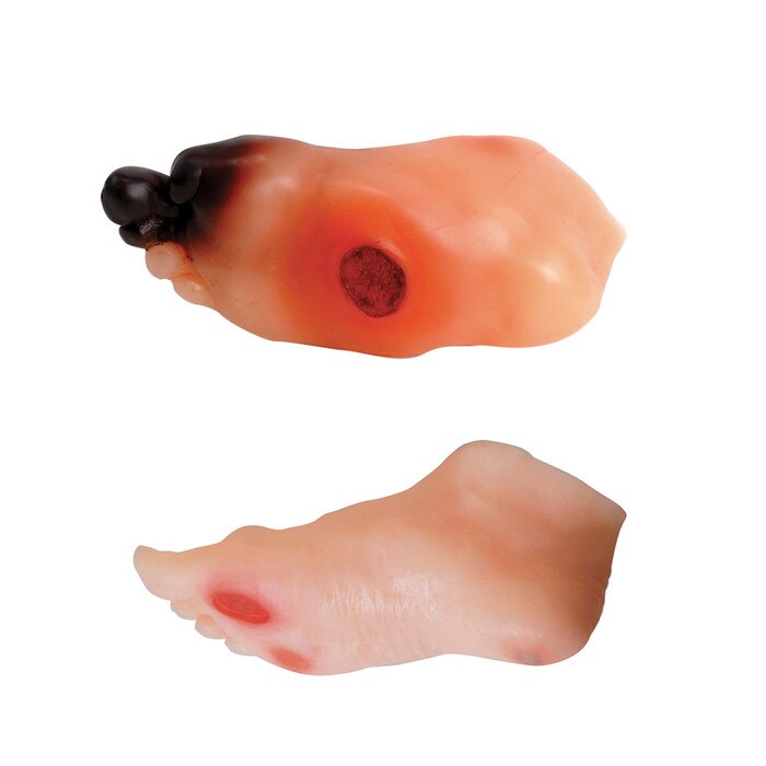 diabetic foot model set, mild and severe ulcer, Charcot foot deformity, sever swelling, redness, gangrene, amputated toe, managing blood glucose, Health Edco, 26160