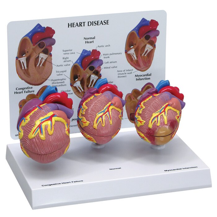 Heart Disease Model Set | Health Edco | Anatomical Models
