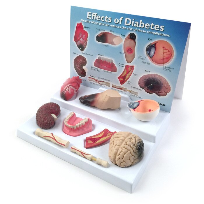 Effects of Diabetes Display for health education from Health Edco with organ models of uncontrolled diabetes effects, 78792