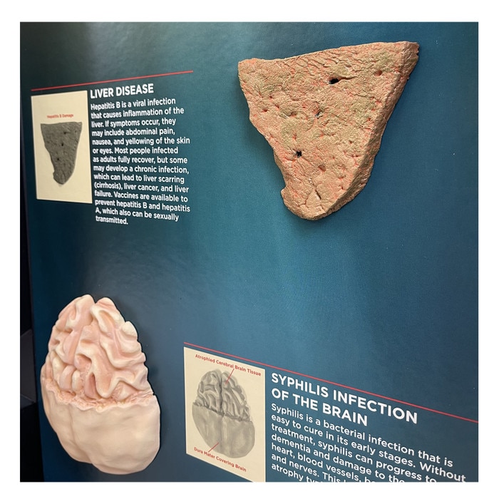 STDs Consequences 3-D Display, models of liver disease and syphilis of the brain in health teaching tool, Health Edco, 78926