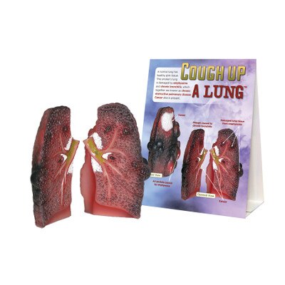 Cough Up a Lung Model for health education from Health Edco showing a smoker's lung with lung cancer and COPD, 78958