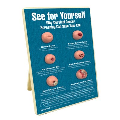 See for Yourself: Why Cervical Cancer Screening Can Save Your Life Easel Display, health models of cervices, Health Edco, 79733