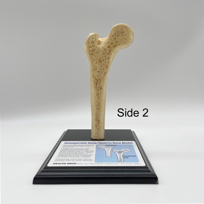 Osteoporotic Bone / Healthy Bone Model, Health Edco health education anatomy model, healthy and unhealthy bone model, 84070